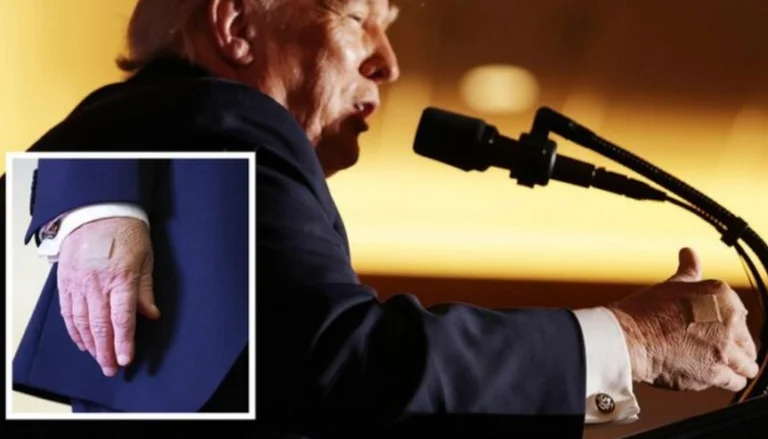 Prezydent Trump pojawia się z bandażami na rękach
