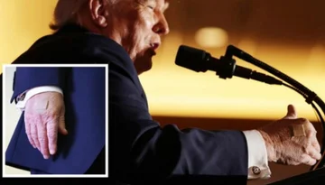 Prezident Trump se objeví s obvazy na rukou