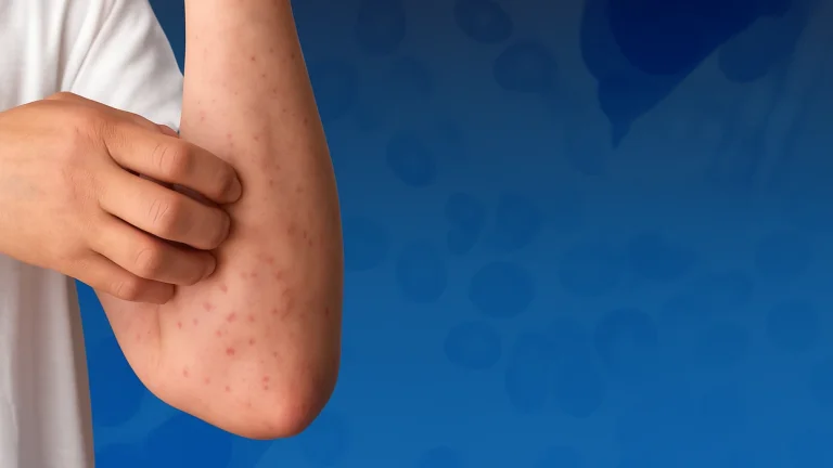 Exhausting, sweating, and fatigue are rare blood diseases that require early treatment and innovative therapy