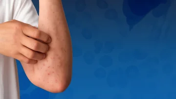 Exhausting, sweating, and fatigue are rare blood diseases that require early treatment and innovative therapy