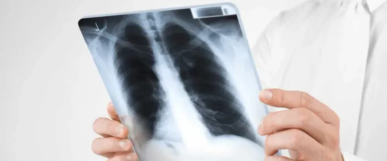 OVR: 2024년 도중 Kosovo에 있는 548의 새로운 tuberculosis 케이스