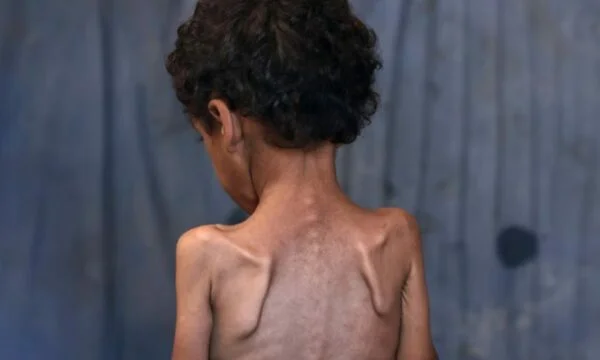 Gaza Kids are starving. What does malnutrition do to the human body?