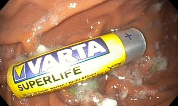 Der zweijährige in Gjilan verschluckte die Fernbatterie, weg vom Magen