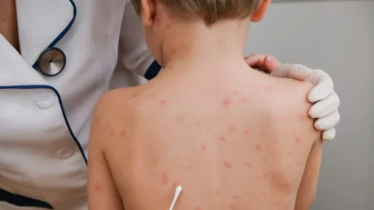 O BSH levanta la alarma: Más del 200% de sarampión en Europa