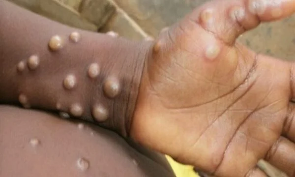 O BSH again declares monkey smallpox a global public health emergency
