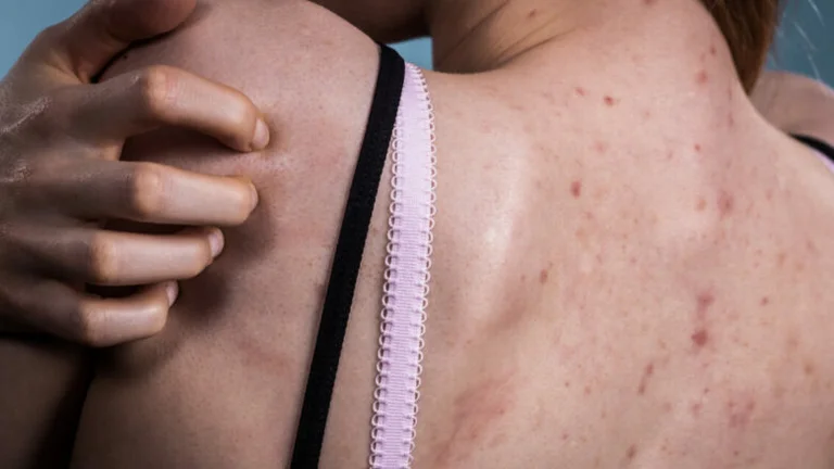 Cosa significa quando una verruca? Chi è in maggior pericolo di essere colpiti da cancro della pelle?
