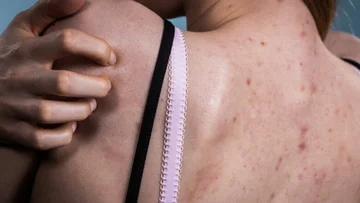 What does it mean when a warpches? Who is in greater danger of being affected by skin cancer?