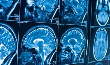 I nove sintomi più comuni del cervello