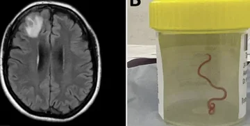 Scientists in Australia first find a live worm in the human brain