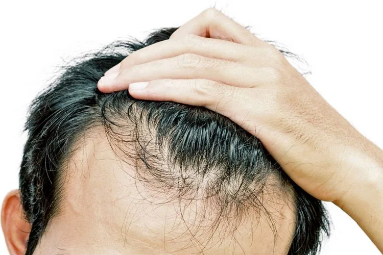 ¿Por qué perdemos el pelo? De Causas a Mitos