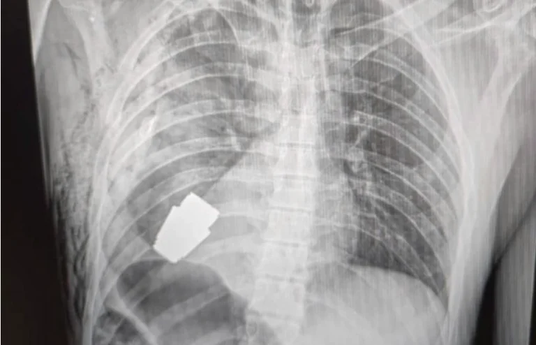 Ukrainian doctors remove an unbroken grenade from a soldier's body