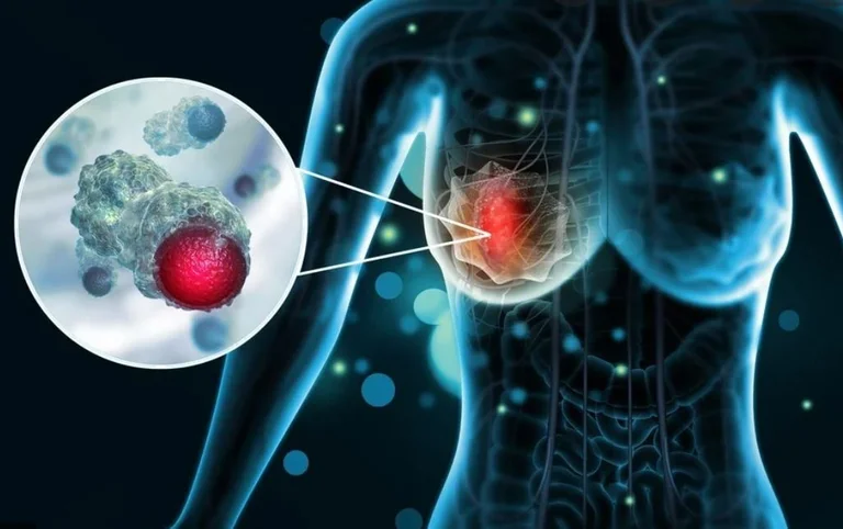 Fase del cancro della baia 0: Fattori di rischio e prevenzione