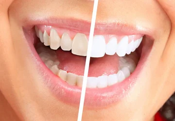 6 Daily Errors That Allow White Tooths