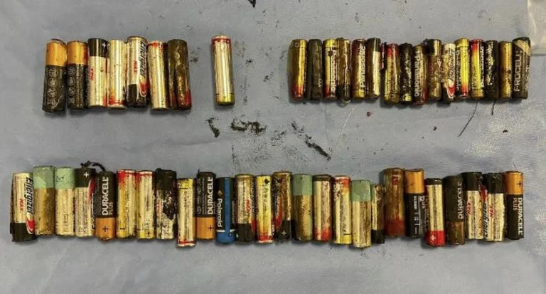 Doctors remove 50 batteries from a woman's belly in Ireland