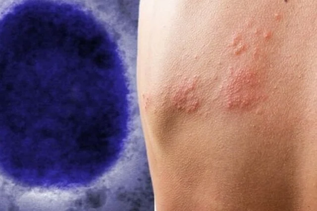 Italiani rezulton pozitiv me COVID, HIV dhe Linë e Majmunit pas një udhëtimi në Spanjë