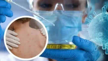 “La maggior parte di coloro che sono stati infettati con la scimmia