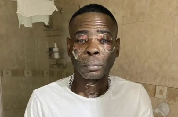 The big boxer suffered terrible burns in the face, no one knows