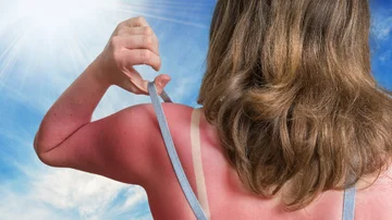 What can you do when you are sunburning?
