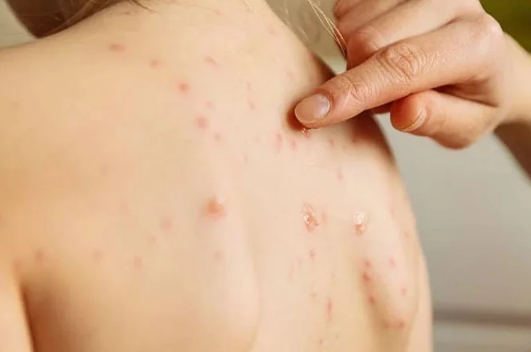 Deuxième cas confirmé avec la variole du singe en Grèce