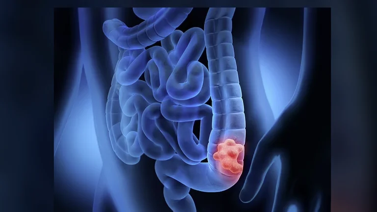 Medicina del cancro dell'intestino, che sta dando agli scienziati la speranza