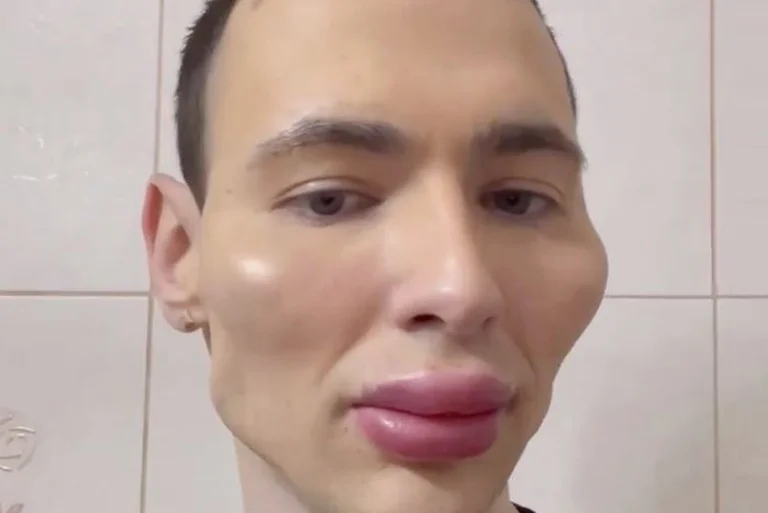 Former Russian soldier “Popeye”, now intends to look alien