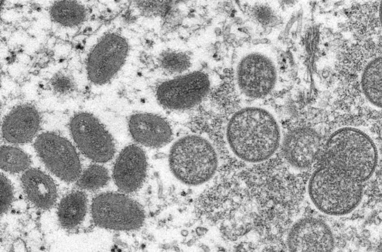 Onze nouveaux cas de variole confirmés au Royaume-Uni