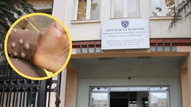 Monkey line, MSH anuncia síntomas, cuidado y tratamiento