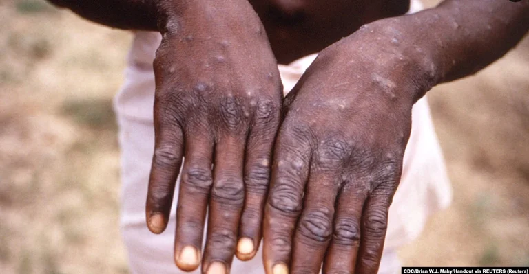 O BSH: 131 cases confirmed by monkeypox