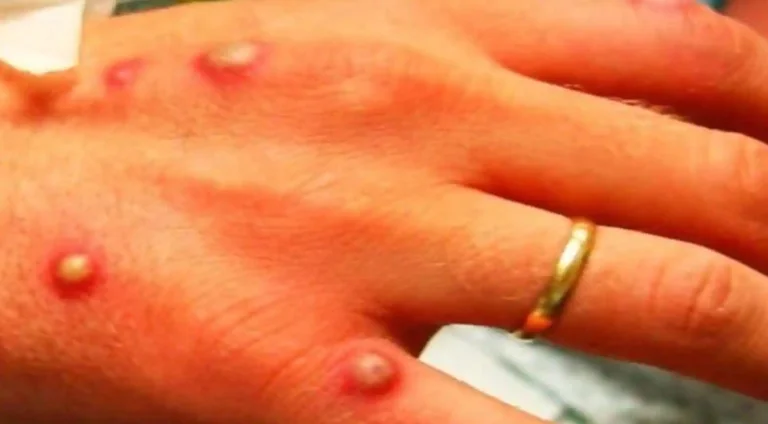 Ce qui est un permis de singe, une infection rare qui a émergé en Europe et aux États-Unis