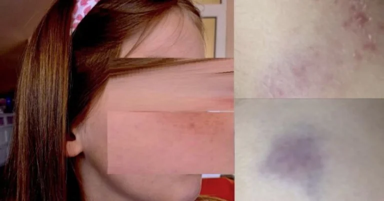 La voiture entre au milieu de “Mère Teresa” à Pristina, frappe une fille de 6 ans