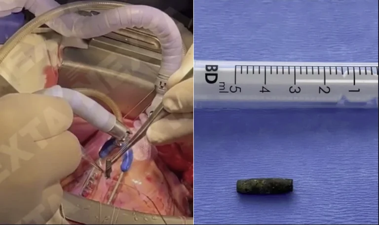 Moments of inspiration: Surgeons extract lead from the heart of wounded Ukrainian soldier