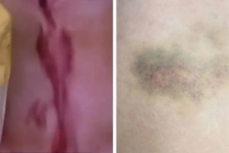 La ragazza di Greenwood ha pubblicato una maledetta foto dopo essere stata brutalmente violata dal calciatore