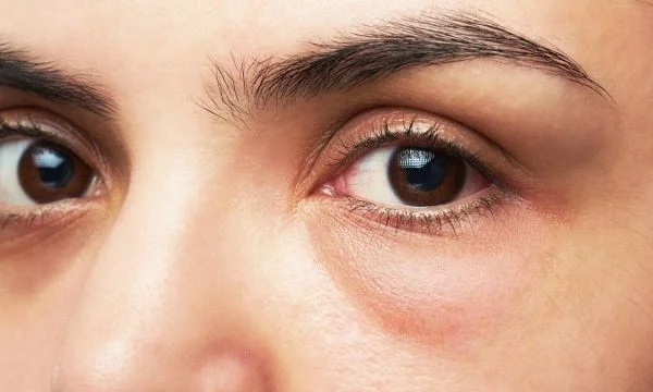 Cosa provoca il gonfiore degli occhi?