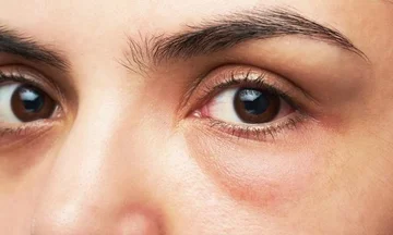 Cosa provoca il gonfiore degli occhi?