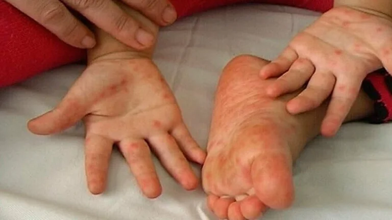 Un virus è mostrato che colpisce i bambini, 15 casi segnalati a QKUK