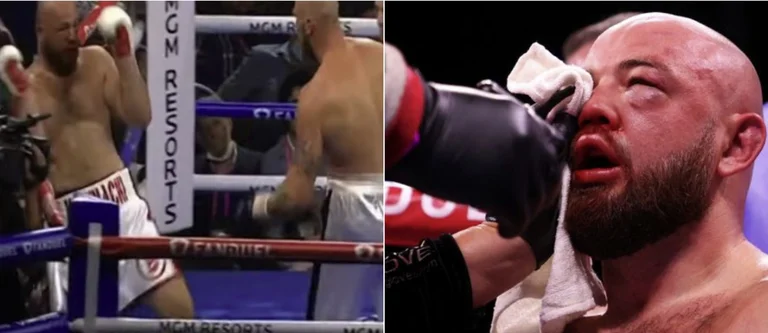 Una vista del horror que el boxeador experimentó en el anillo: Sufrió tan mal que ni siquiera puede soplar la nariz.