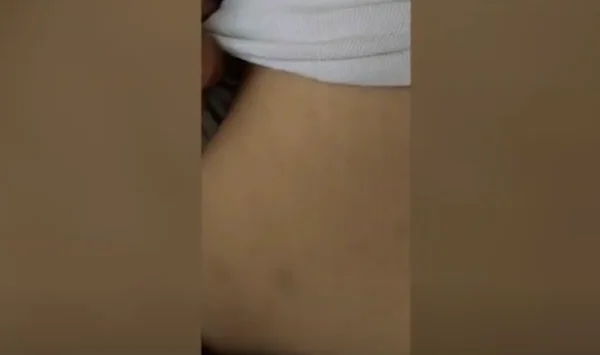 Nëna dyshon se një qendër trajtimi ka ushtruar dhunë fizike ndaj vajzës së saj me Sindrom Down