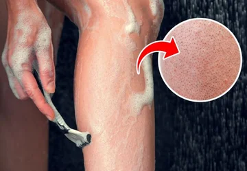 Skin milkberries: What causes it and how to treat it at home