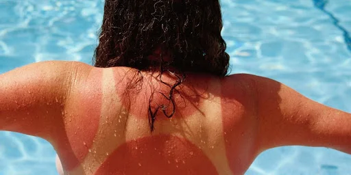 Metodi efficaci di manipolazione della pelle bruciata dal sole