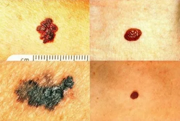 These skin alarms indicate dangerous diseases