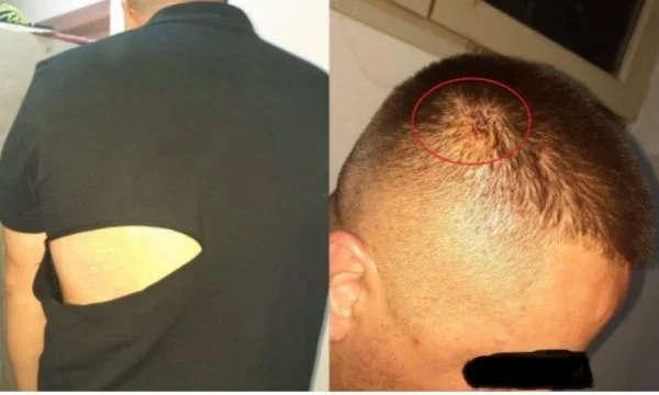 Version policière du passage à tabac à Gjilan: Ils lui ont cassé la bouteille de bière dans la tête.