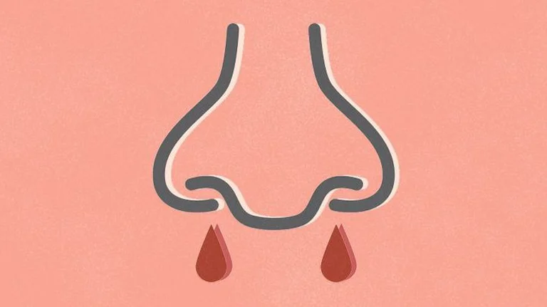 Is nosebleed a Symptom of Coddy?