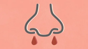 Is nosebleed a Symptom of Coddy?