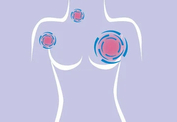 Researchers discover a gene responsible for one of the deadliest species of breast cancer