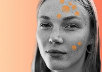 All you need to know about hyperpigmentation