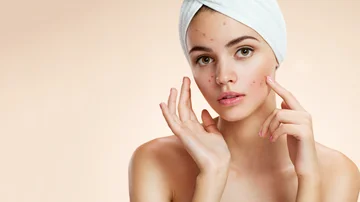 Facial acne causes you didn't know they could be guilty