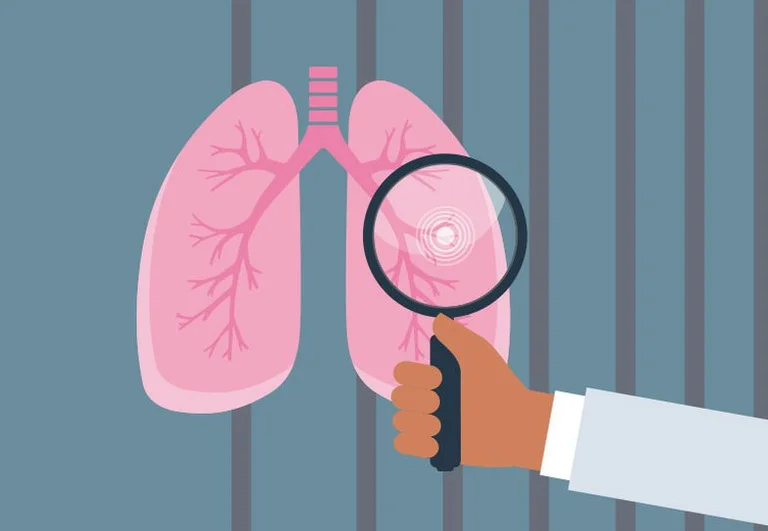 Lung Cancer: 1 person in 5 is not a smoker or other causes