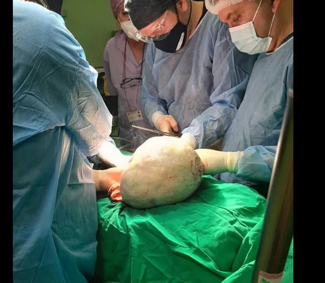 Doctors at Mitrovica Hospital remove a patient's 15kg - weighted tumor