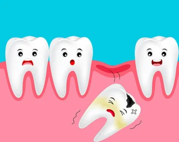 How can you understand when you should (or not) remove the teeth of maturity
