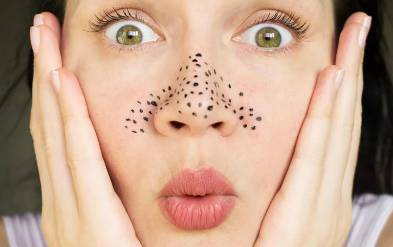 Black dots: What causes them, how you treat them, and what you do